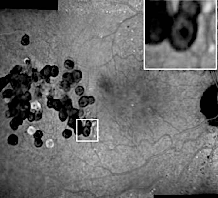 Les Larges Drusen Collo Des Du Sujet Jeune Cr Teil Ophtalmo